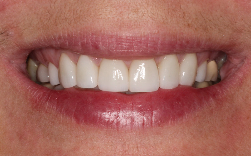 Before & After Pictures General and Cosmetic Dentistry Rincon Dental