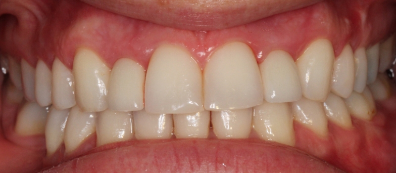2 implant crowns after 2 implant crowns after