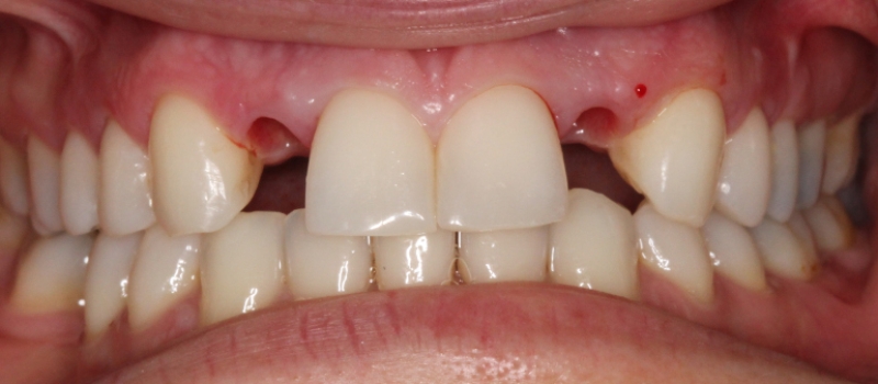 2 implant crowns before 2 implant crowns before