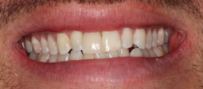 single implant crown after single implant crown after