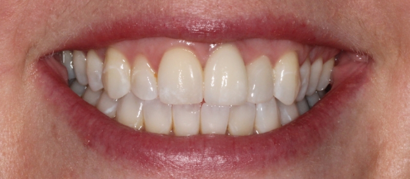 single implant crown and single porcelain veneer after single implant crown and single porcelain veneer after