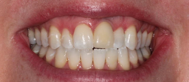 single implant crown and single porcelain veneer before single implant crown and single porcelain veneer before