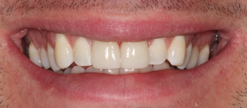 A smiling person showing nice veneers