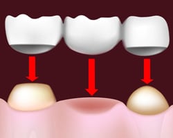 Dental Bridge