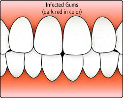 gingivitis