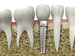 implant-model