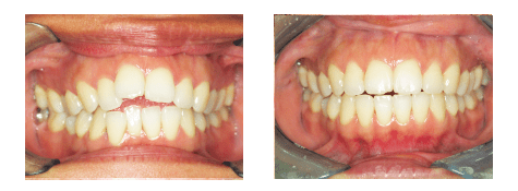 invisalign-before-after