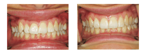 invisalign-before-after2
