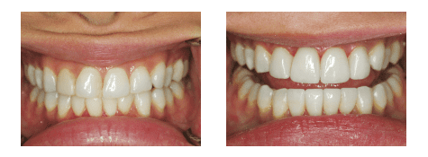 veneers-before-after