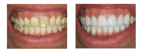 veneers-before-after2