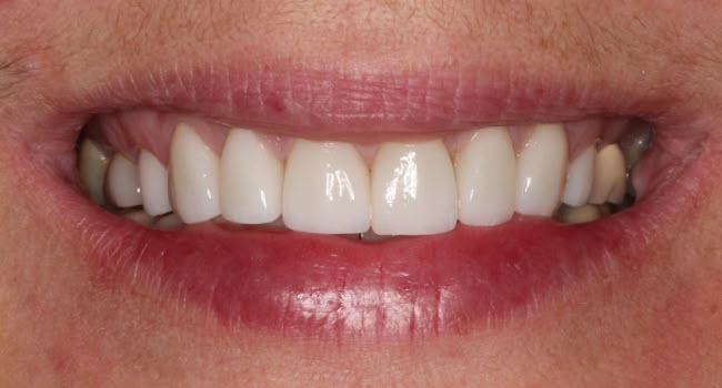 A smiling person showing healthy, white teeth in a close-up dental image.