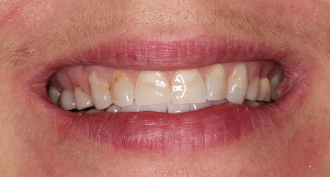 A healthy smile with stained teeth