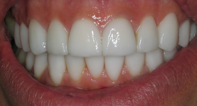 10 upper and 10 lower pocelain veneers after