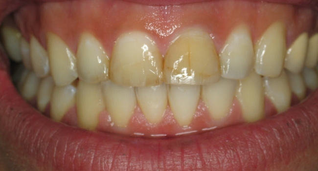 10 upper and 10 lower pocelain veneers before 10 upper and 10 lower pocelain veneers before