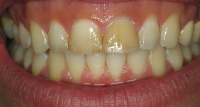 10 upper and 10 lower pocelain veneers before