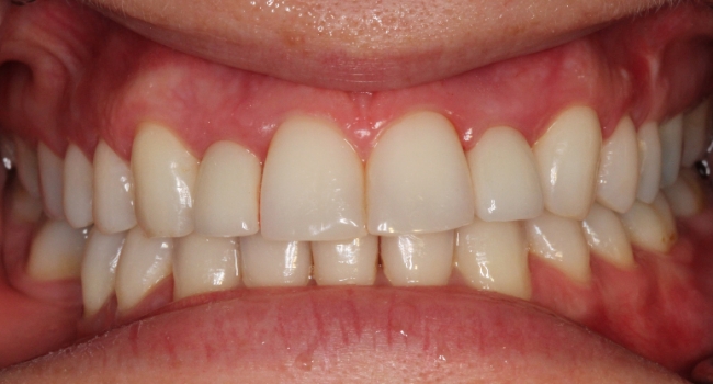2 implant crowns after 2 implant crowns after