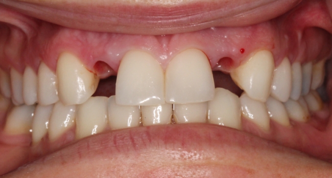 2 implant crowns before 2 implant crowns before