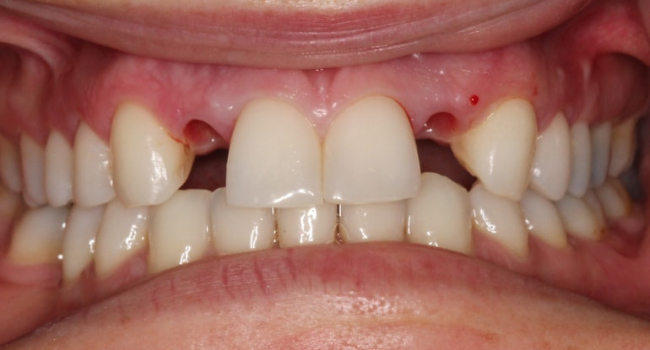 2 implant crowns before