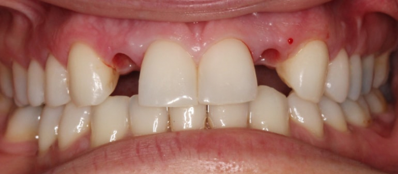2 implant crowns before