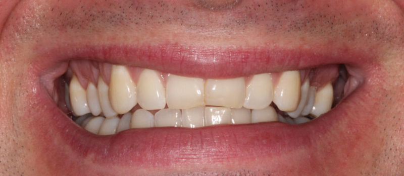 2 porcelain veneers before