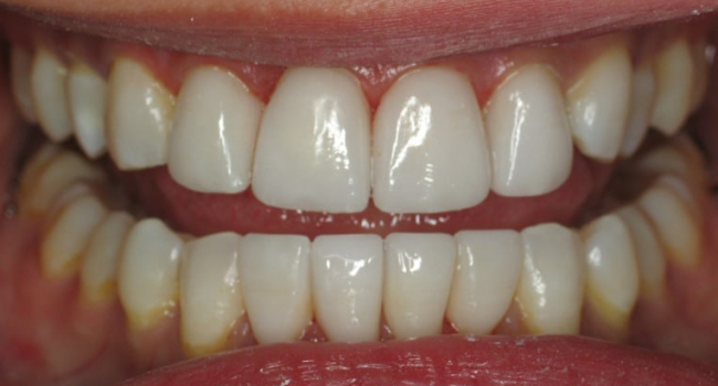 4 upper and 4 lower pocelain veneers after