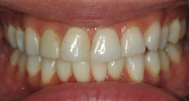 4 upper and 4 lower pocelain veneers before 4 upper and 4 lower pocelain veneers before