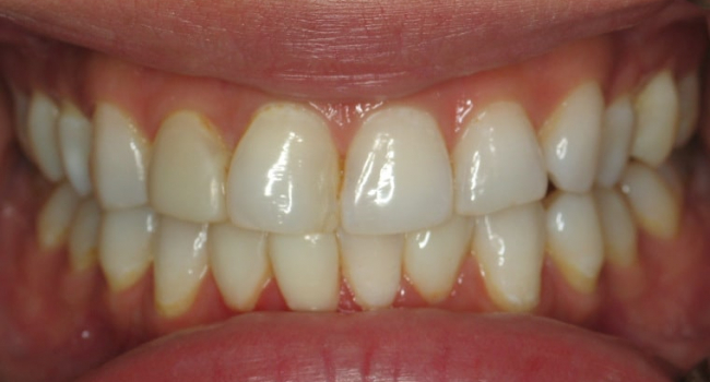 4 upper and 4 lower pocelain veneers before