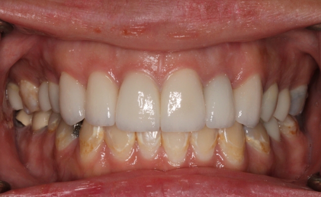 6 anterior crowns after