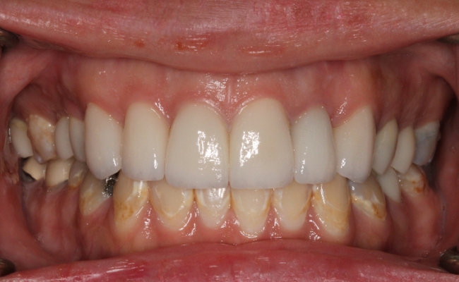 6 anterior crowns after 6 anterior crowns after