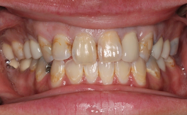 6 anterior crowns before 6 anterior crowns before