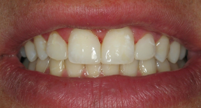 closing gaps with direct bonding after closing gaps with direct bonding after