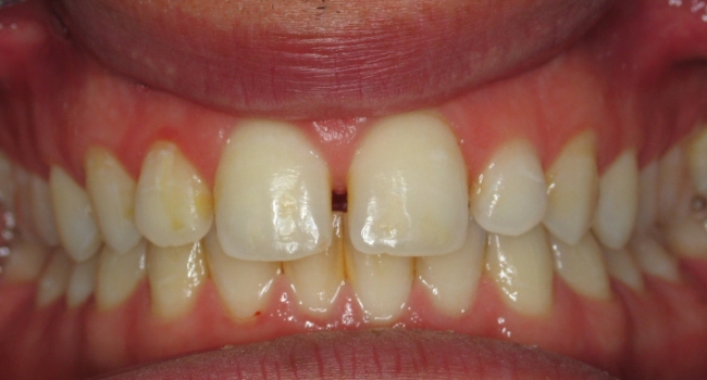closing gaps with direct bonding before closing gaps with direct bonding before