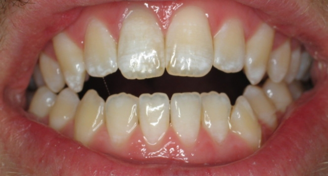 internal bleaching a darkened tooth after