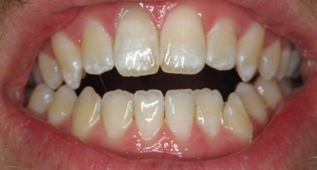 internal bleaching a darkened tooth after internal bleaching a darkened tooth after