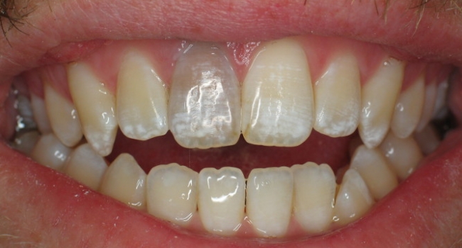 internal bleaching a darkened tooth before internal bleaching a darkened tooth before