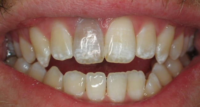 internal bleaching a darkened tooth before