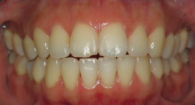 invisalign 1 after invisalign 1 after