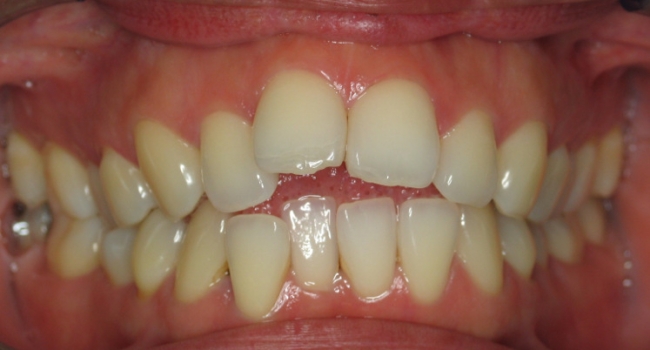 invisalign 1 before invisalign 1 before