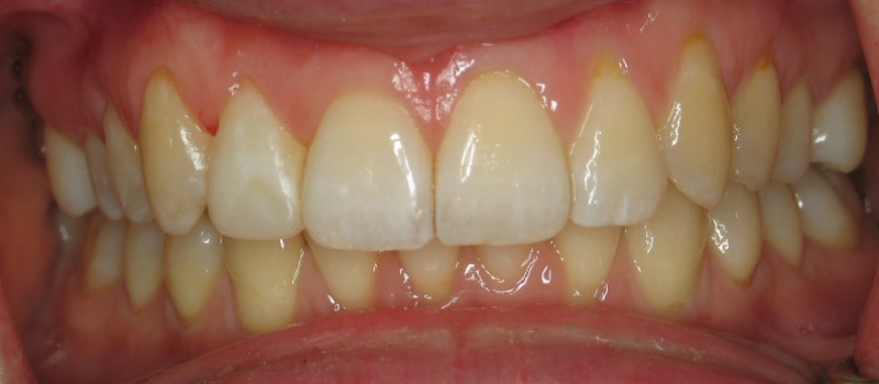 invisalign 2 after