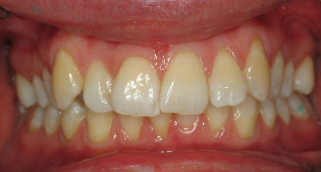 invisalign 2 before