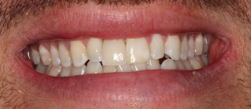 single implant crown after
