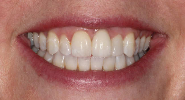 single implant crown and single porcelain veneer after