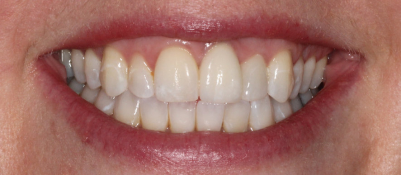 single implant crown and single porcelain veneer after