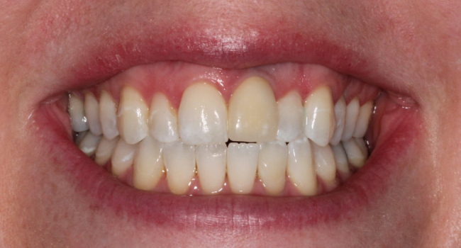 single implant crown and single porcelain veneer before