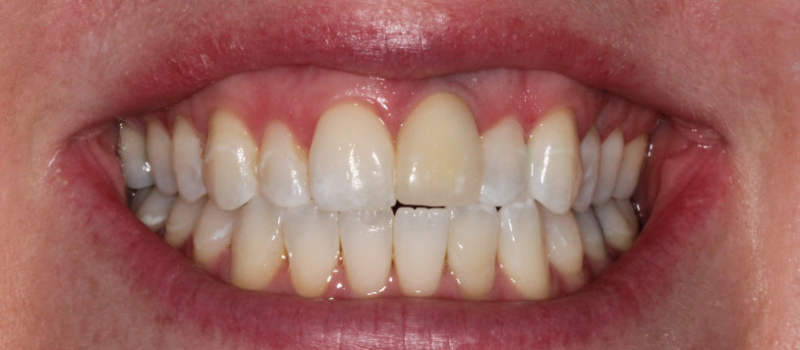 single implant crown and single porcelain veneer before