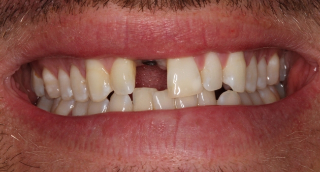 single implant crown before single implant crown before
