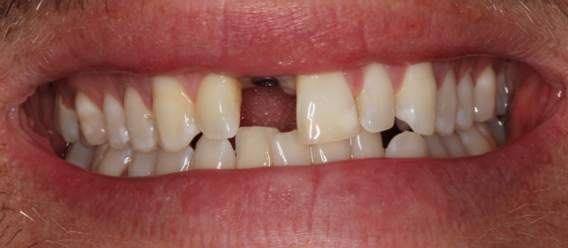 single implant crown before