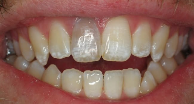 A healthy smile with misaligned and stained teeth