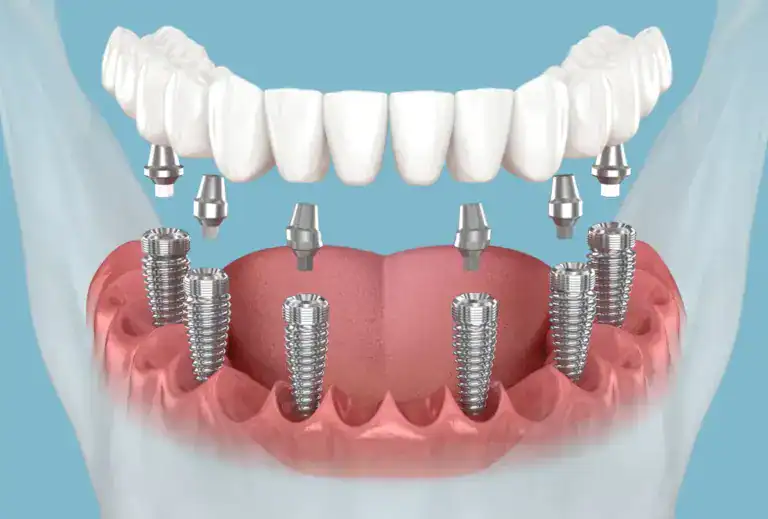 Dental implant-supported dentures with multiple implants in the lower jaw.