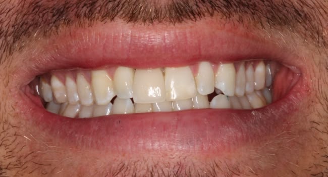 A smiling person showing healthy teeth and gums at Rincon Dental clinic.